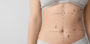 Free Liposuction Consultations in Arlington VA